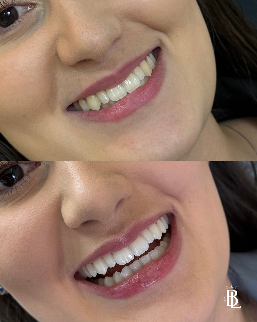 Antes e depois do Protocolo ARMÔNI com clareamento dental — Bélari Clinic Diadema