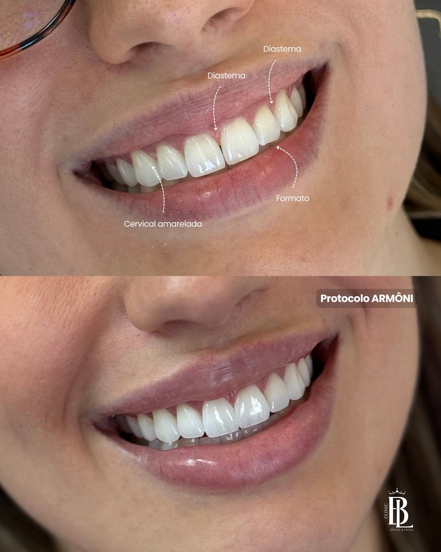 Antes e depois de estética dental com o Protocolo ARMÔNI — Bélari Clinic Diadema