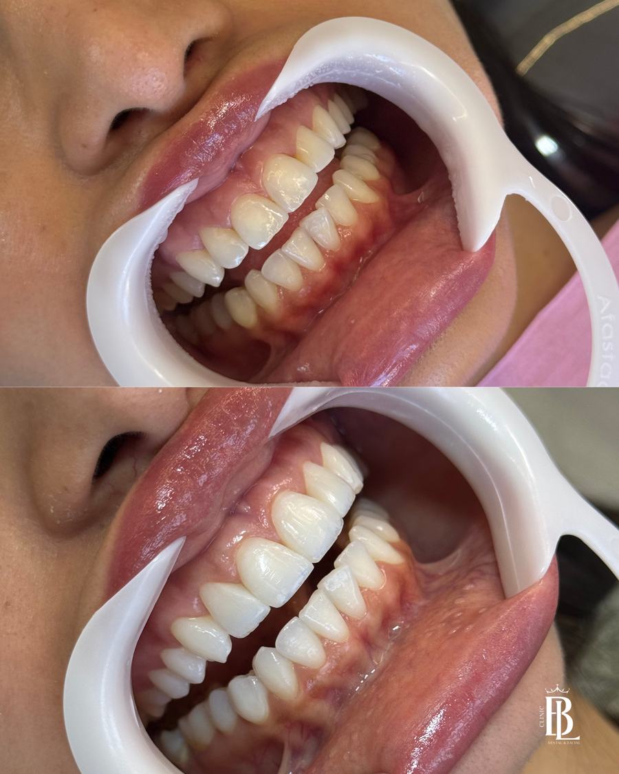 Antes e depois do Protocolo ARMÔNI com remoção de resinas — Bélari Clinic Diadema
