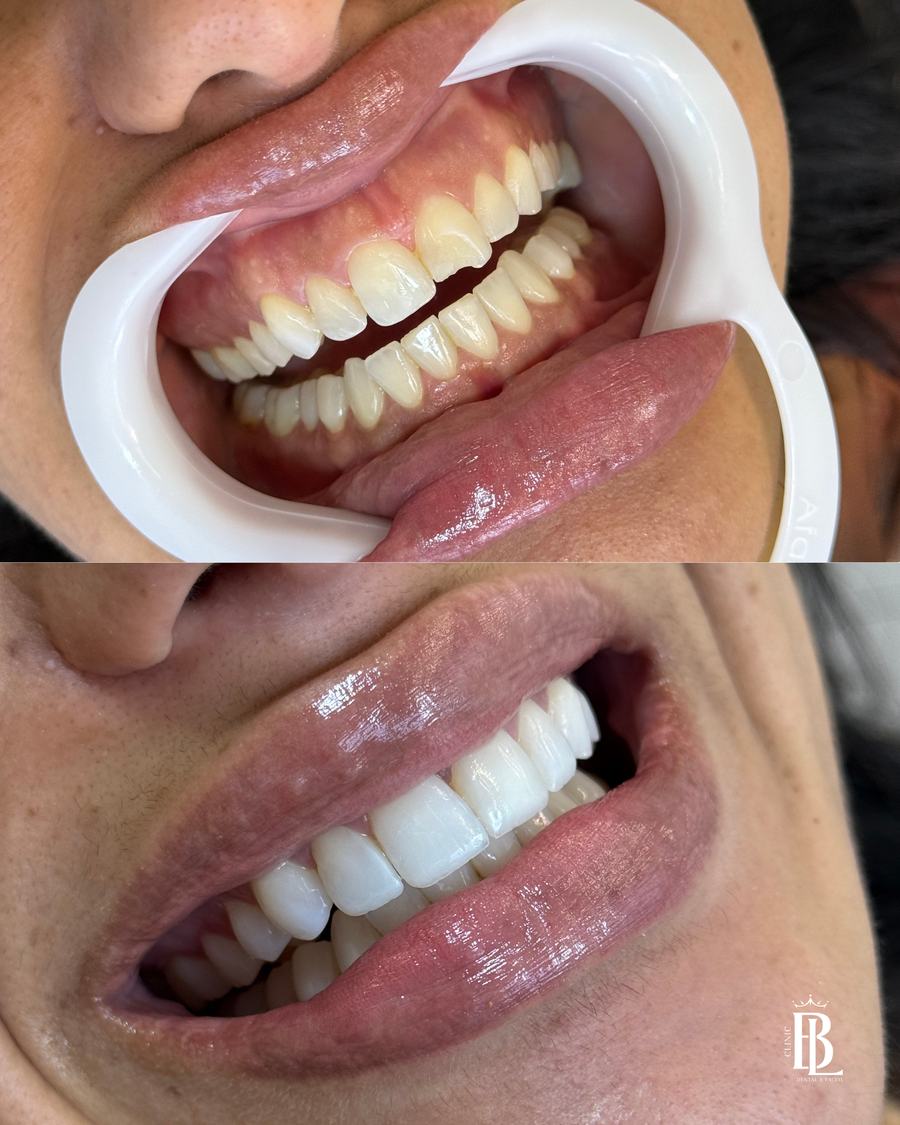 Antes e depois do Protocolo ARMÔNI com acréscimos em resina — Bélari Clinic Diadema