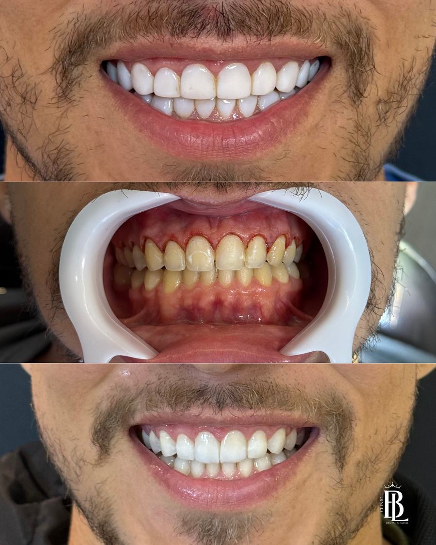 Antes e depois do Protocolo ARMÔNI com remoção de resinas — Bélari Clinic Diadema