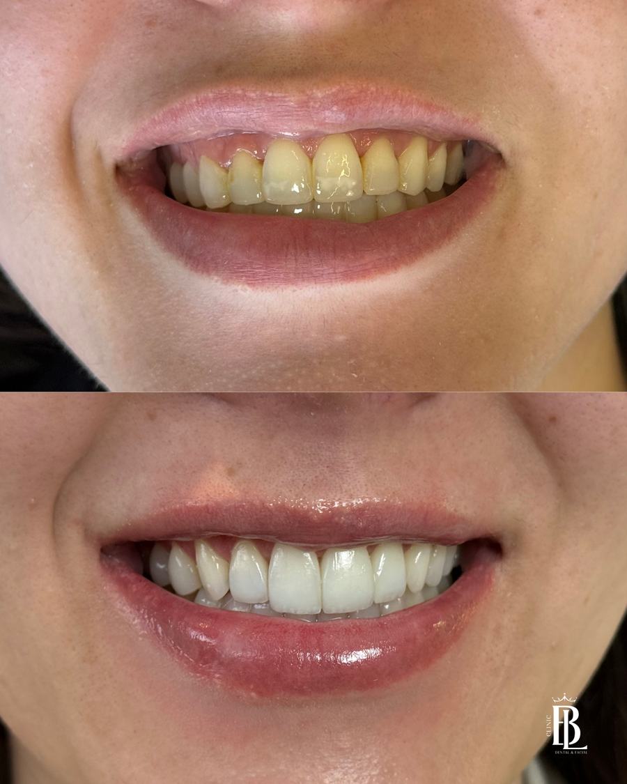 Antes e depois do Protocolo ARMÔNI com clareamento, gengivoplastia e recontorno — Bélari Clinic Diadema