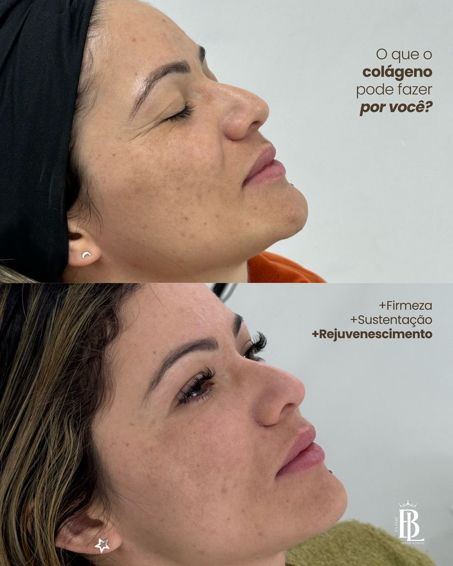 Firmeza e rejuvenescimento com bioestimulador — Bélari Clinic