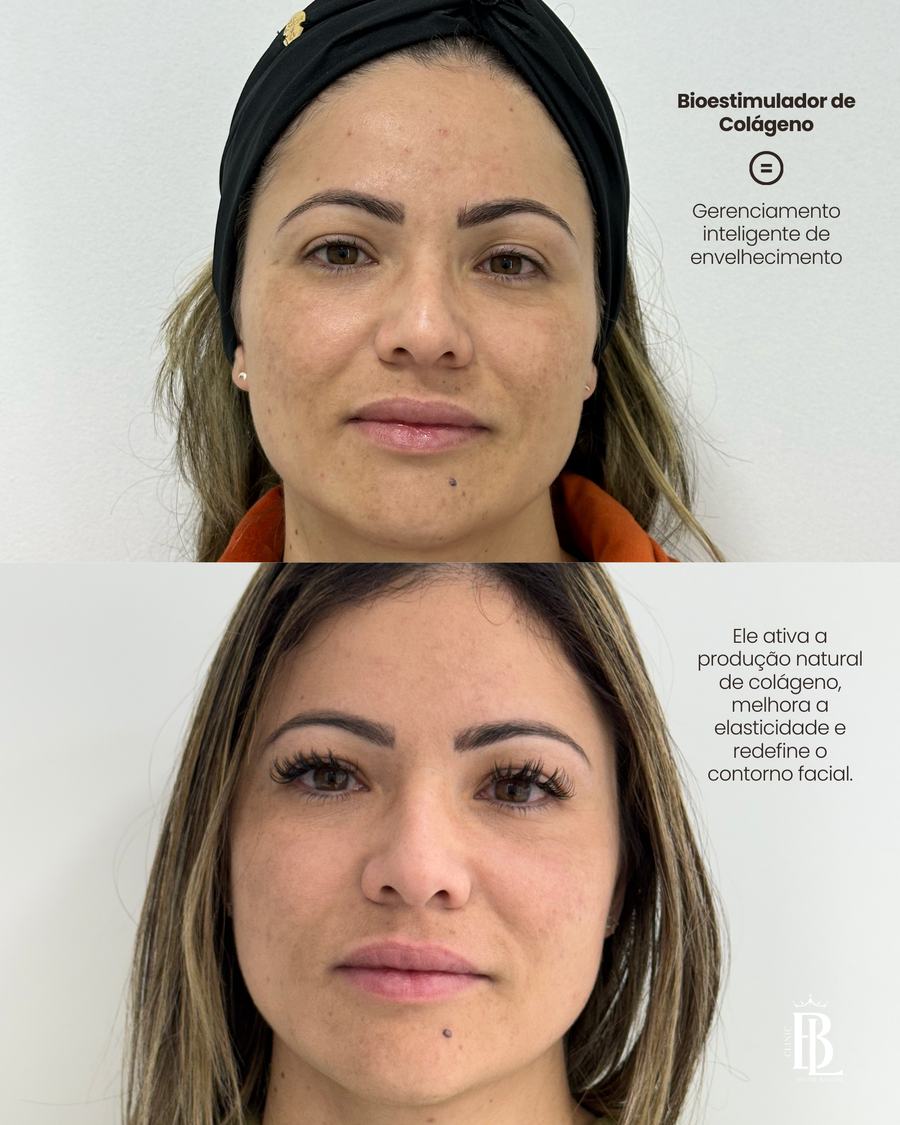 Antes e depois de bioestimulador de colágeno — Bélari Clinic Diadema