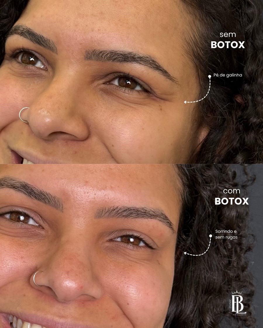 Antes e depois de Botox em Diadema — expressão natural