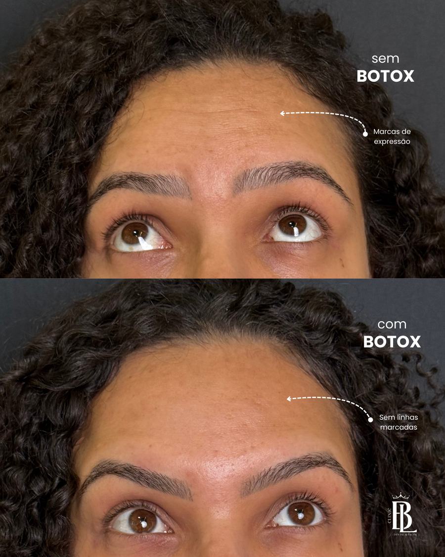 Antes e depois de Botox — harmonização facial em Diadema