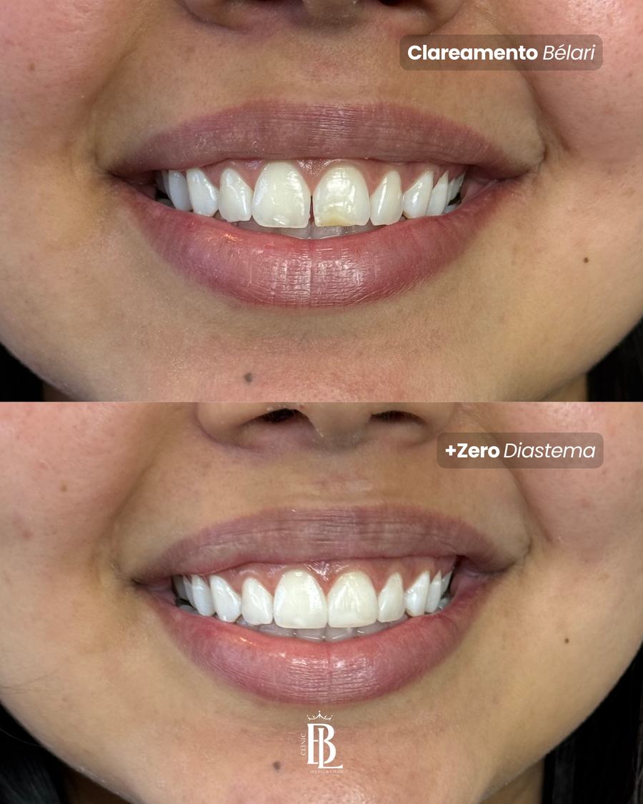 Antes e depois de fechamento de diastema — Bélari Clinic Diadema