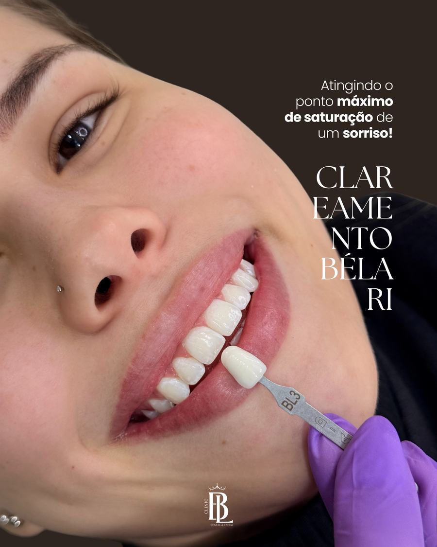 Sessão de clareamento dental em Diadema — Clareamento Bélari