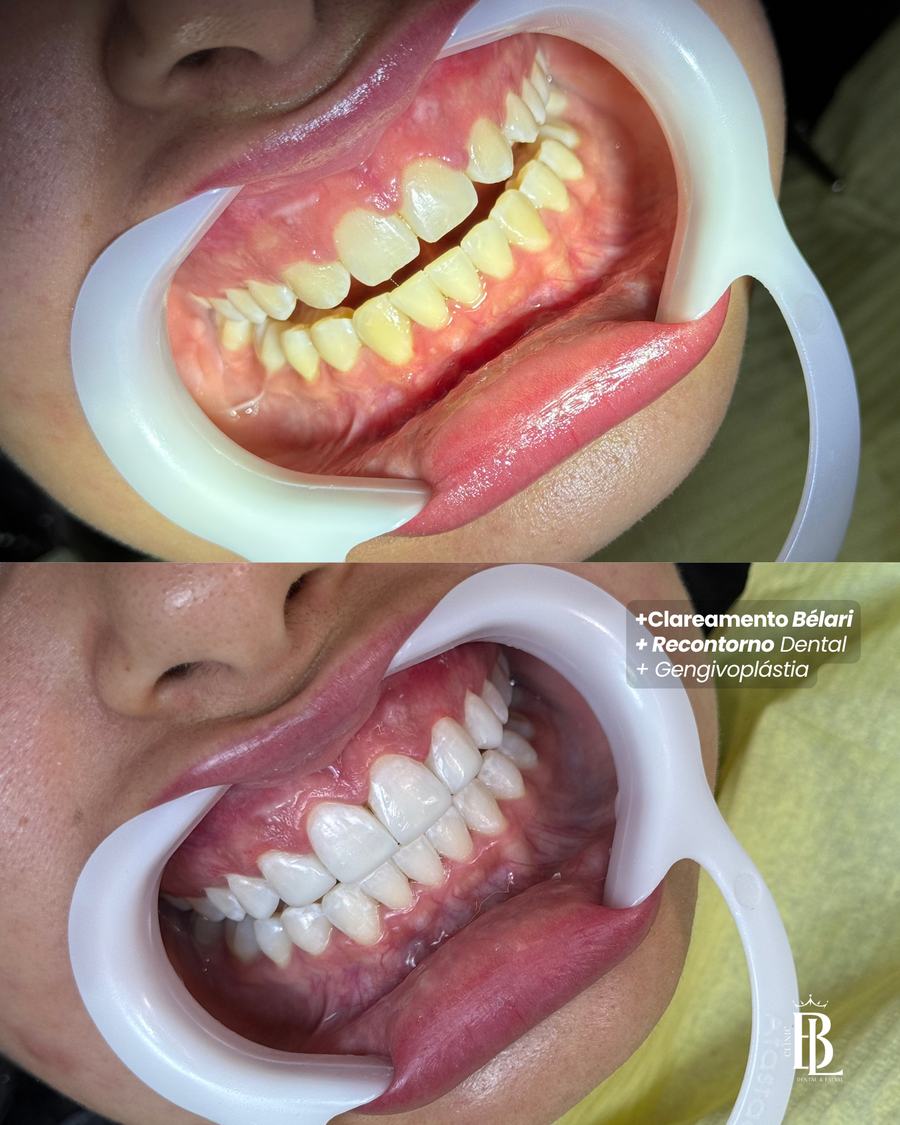 Antes e depois de gengivoplastia e clareamento — Bélari Clinic Diadema