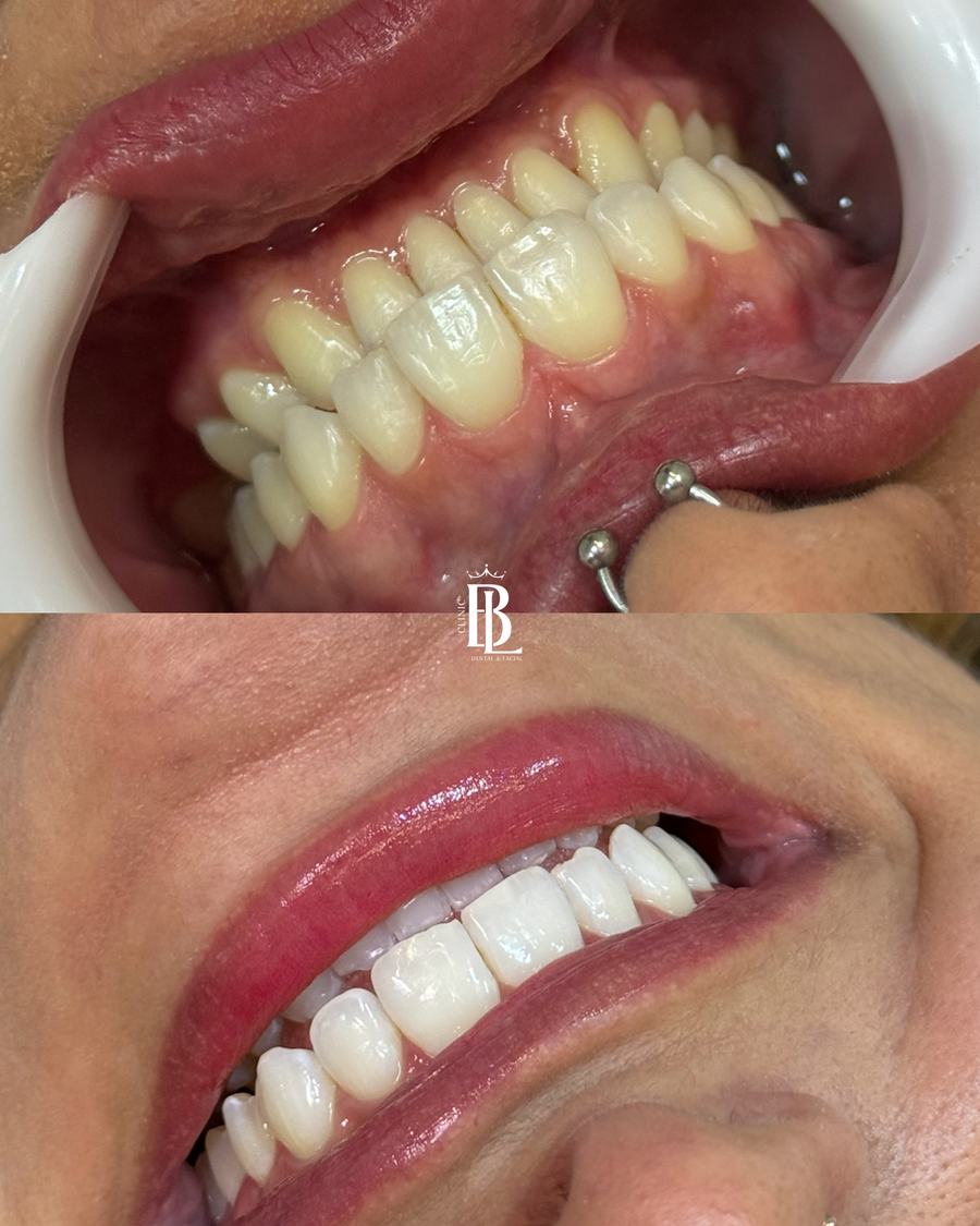 Antes e depois de clareamento dental em Diadema — Clareamento Bélari