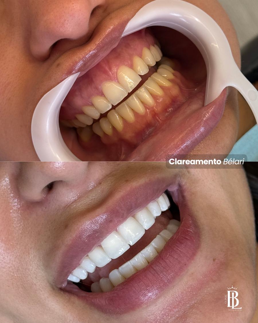 Antes e depois do Protocolo ARMÔNI — Bélari Clinic Diadema