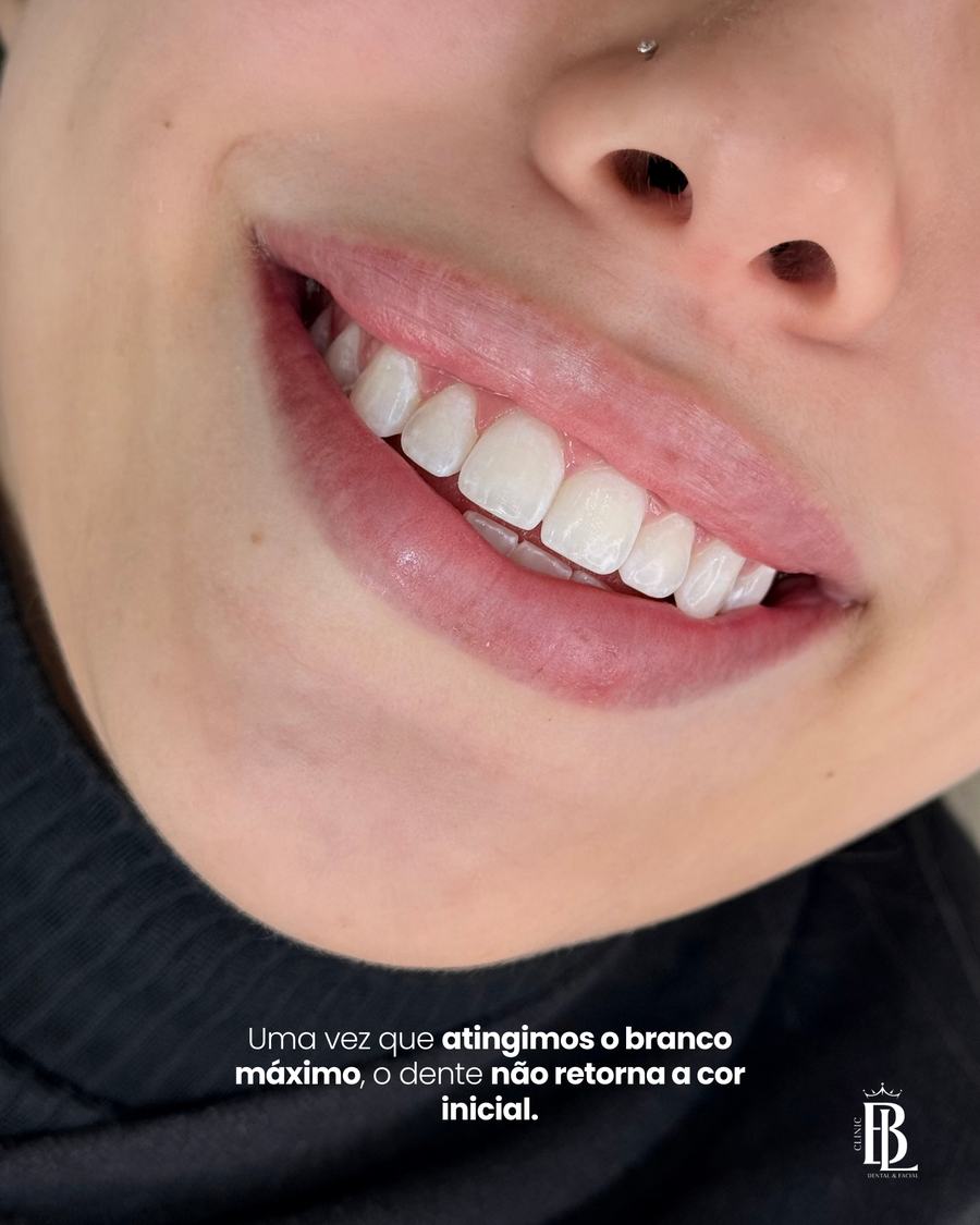 Antes e depois do Clareamento Bélari — branco máximo do dente