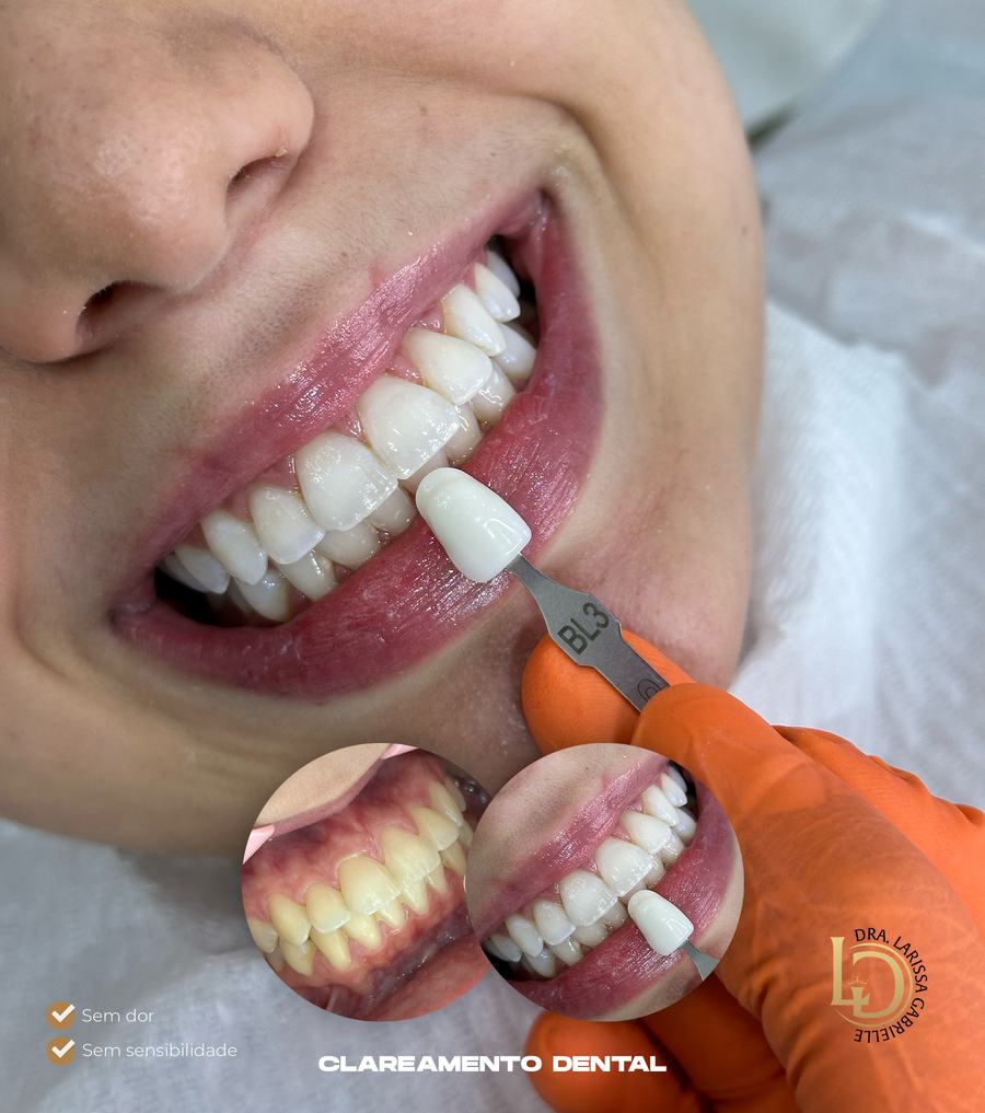 Verificação da cor do dente durante o Clareamento Bélari em Diadema