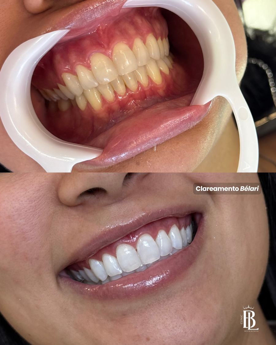 Antes e depois de clareamento dental em Diadema — Clareamento Bélari