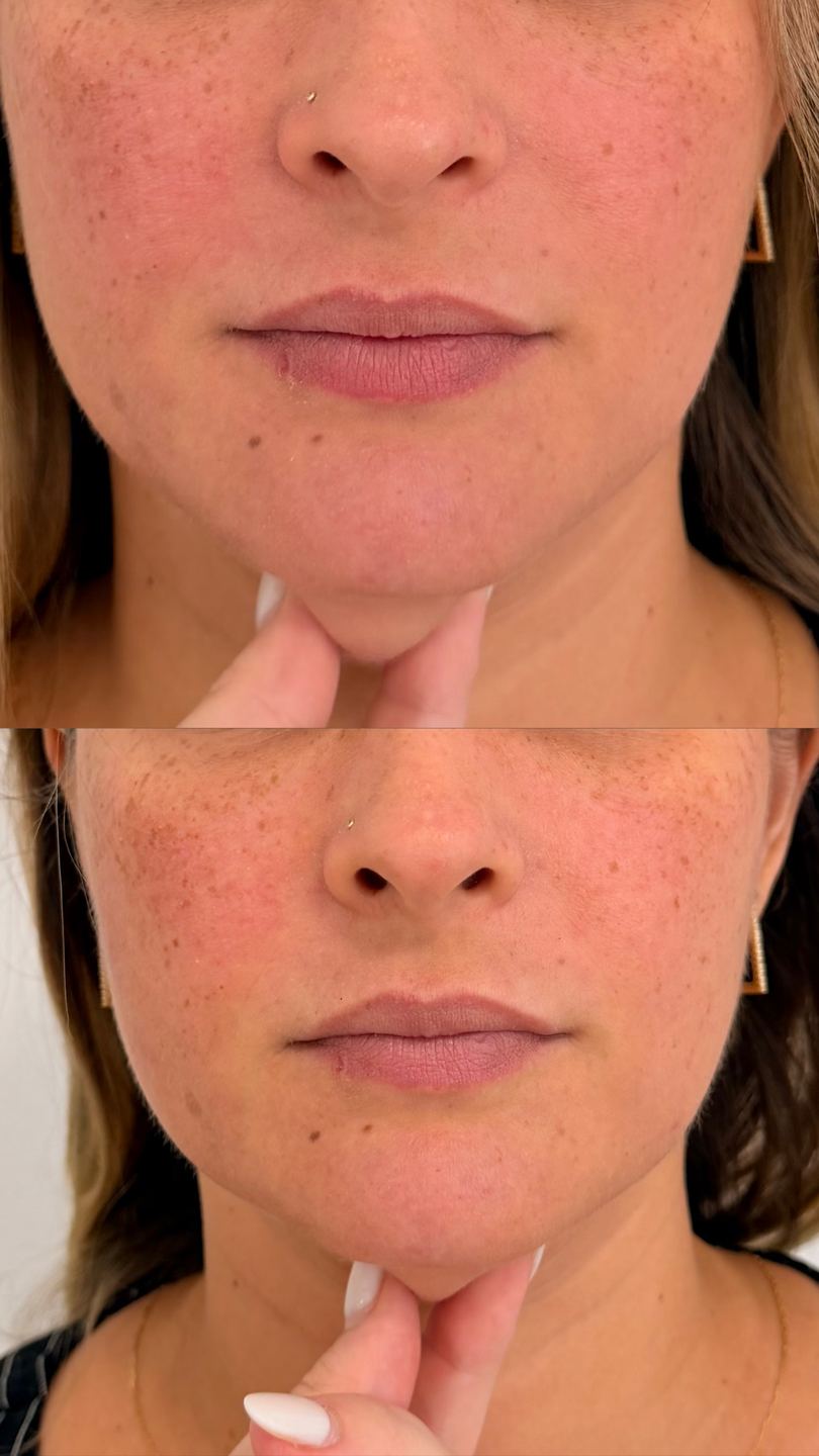 Antes e depois de tratamento facial — qualidade de pele, Bélari Clinic Diadema