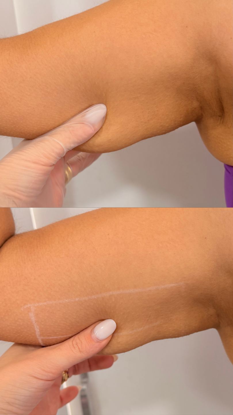 Antes e depois de HiPRO — firmeza e contorno, Bélari Clinic Diadema