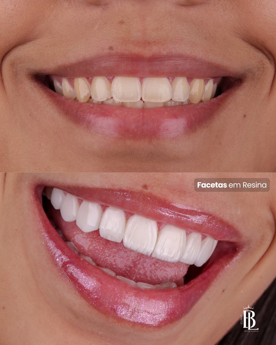Antes e depois de lentes em resina em Diadema — Bélari Clinic