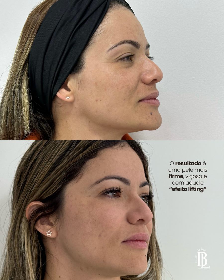 Efeito lifting com estímulo de colágeno — Bélari Clinic Diadema