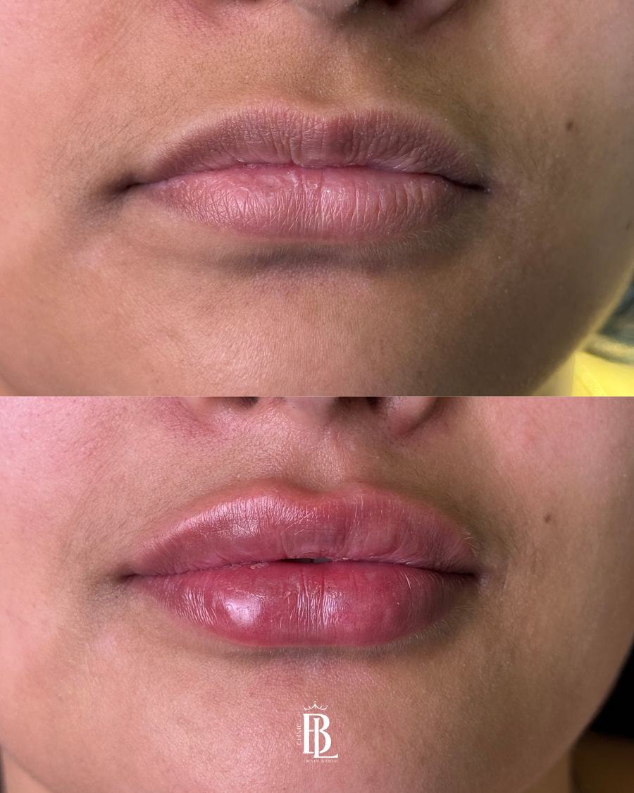 Antes e depois de preenchimento labial em Diadema — Bélari Clinic