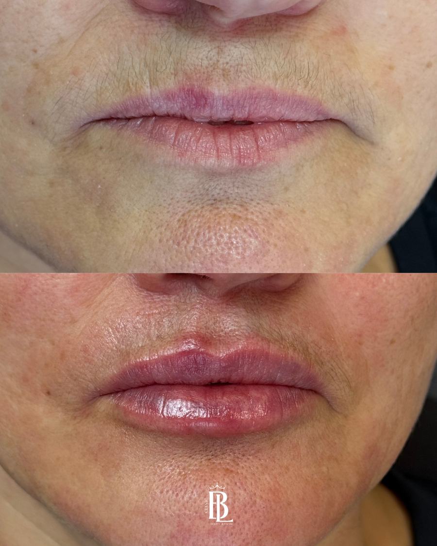 Antes e depois de preenchimento labial — Bélari Clinic Diadema
